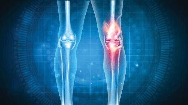Sports Injuries | Knee Total Replacement - Dr V Punjabi, Wollongong, Sydney